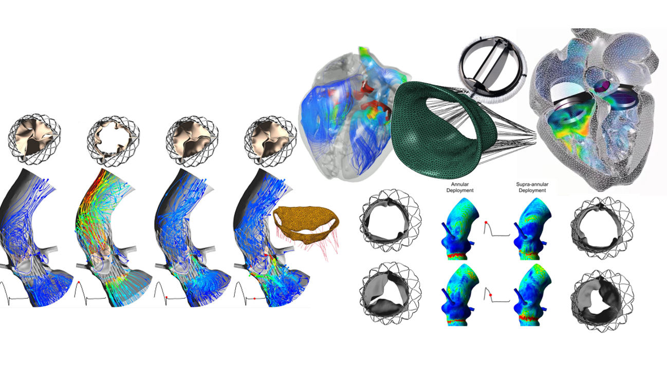 Discover: Cardiac CFD/FSI Simulations with FlowVision